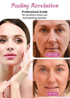 30ml Skin Peeling Serum / Professional Grade Liquid Set cho Face Skin Exfoliation Solution
