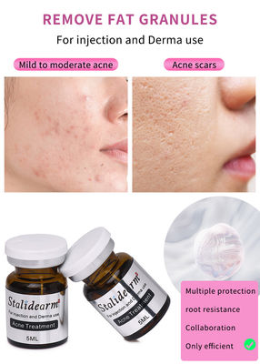 Stalidearm Dermal Fillers Điều trị mụn trứng cá Serum tiêm để chữa mụn trứng cá và giảm vết bẩn