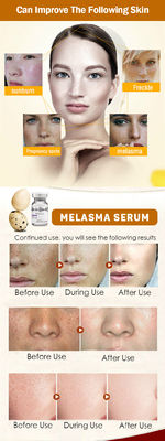 Tinh chất dưỡng da Meso Serum Microneedling Loại bỏ tàn nhang Serum trị nám Làm trắng da