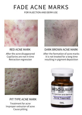 Điều trị mụn bằng tiêm Mesotherapy Luxury Youth Serum Injection Red Spots