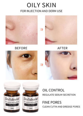 Serum tiêm cho da nhờn 5ml / chai Bộ tinh chất hiệu quả tốt an toàn